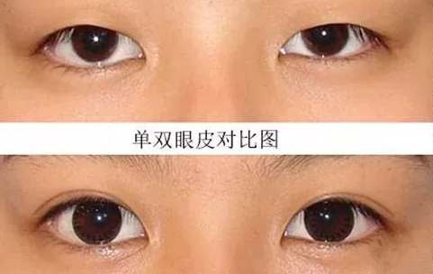 內雙眼皮定義