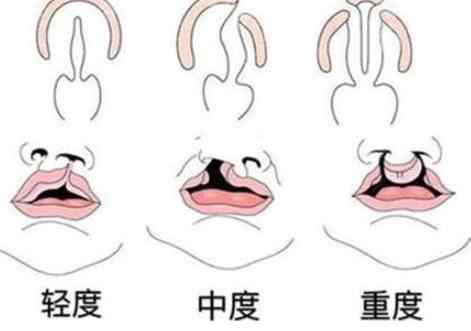 唇顎裂照護