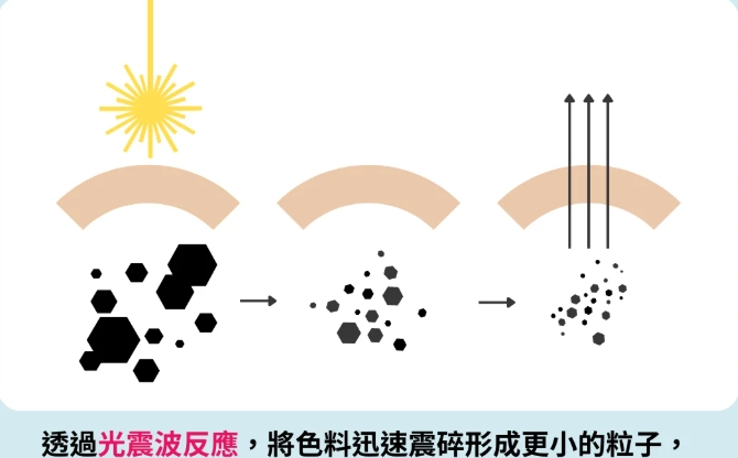無創除色紅腫