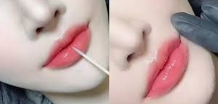 嘟嘟唇後遺症