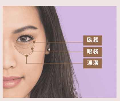 淚溝類型