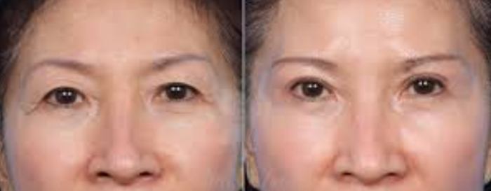 雙眼皮手術推薦