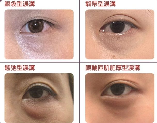 淚溝醫美療程