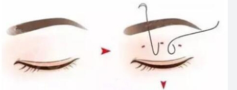 內雙眼皮