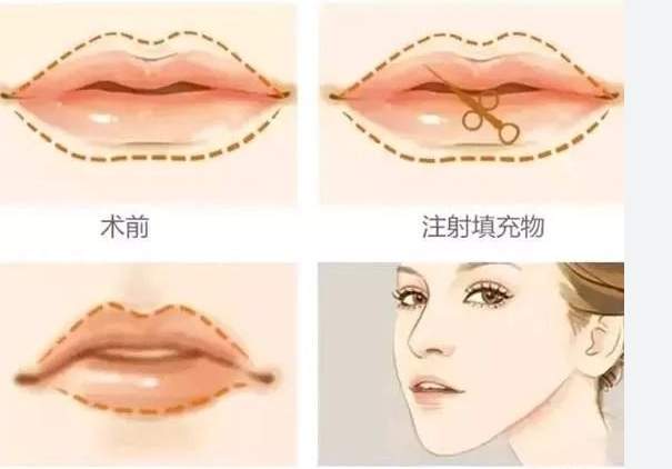 嘟 嘟 唇