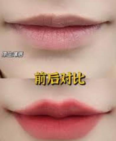 微笑唇微整前必知