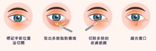 按摩消除淚溝