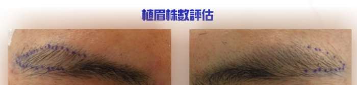 植眉毛後養護