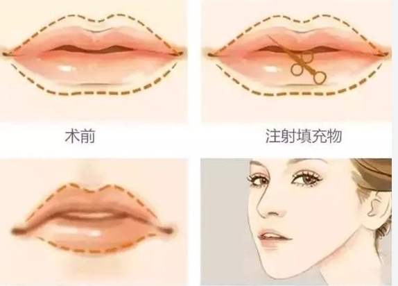 如何打造微笑唇