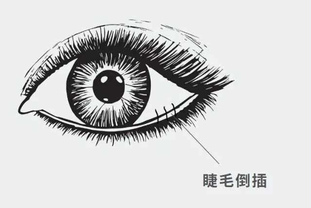 睫毛倒插常見症狀