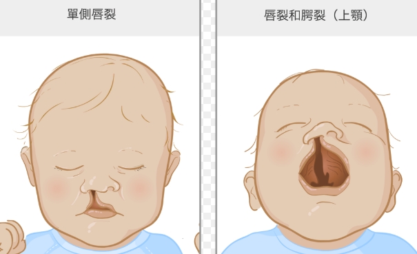 唇裂預防