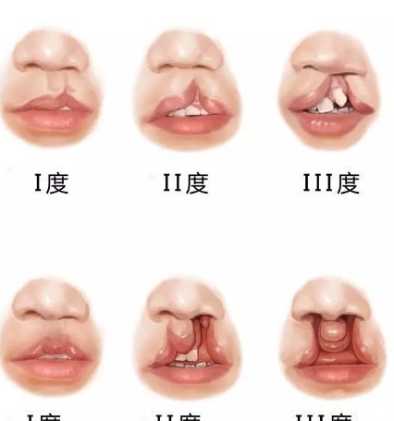 唇裂原因