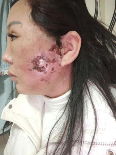 整容手術的後遺症 整容手術的後遺症
