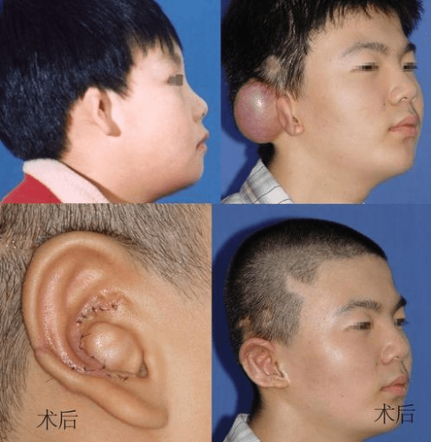 耳朵畸形手術 耳朵畸形手術