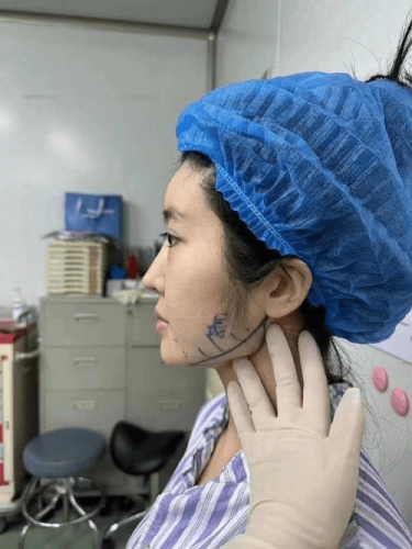 削骨整形費用
