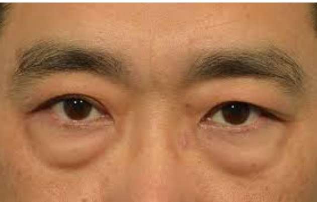淚溝凹陷 淚溝凹陷
