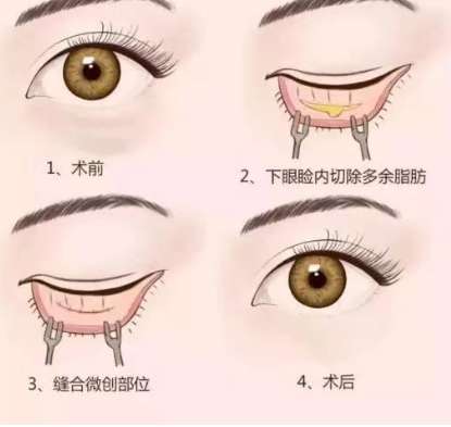 眼袋消除 眼袋消除