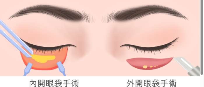 眼袋消除手術 眼袋消除手術