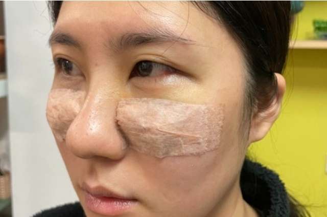 眼袋手術恢復期 眼袋手術恢復期